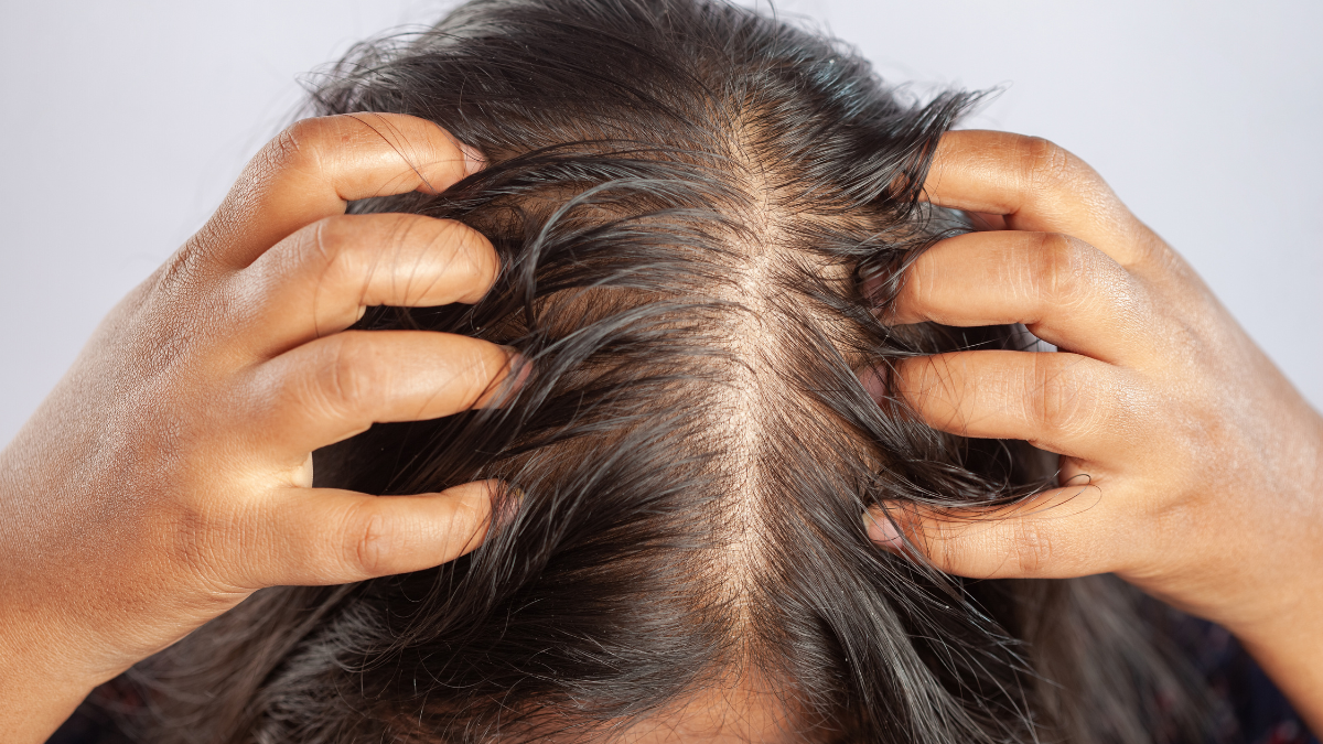 Persona con el cabello graso.